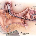 Esquema implante coclear